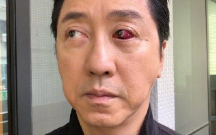 庾澄庆眼睛受伤